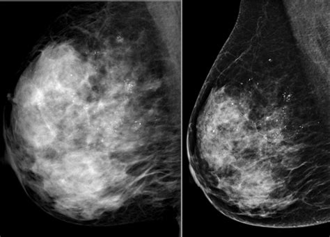 the villages breast cancer mammogram|PHOTO GALLERY: What does breast cancer look like .